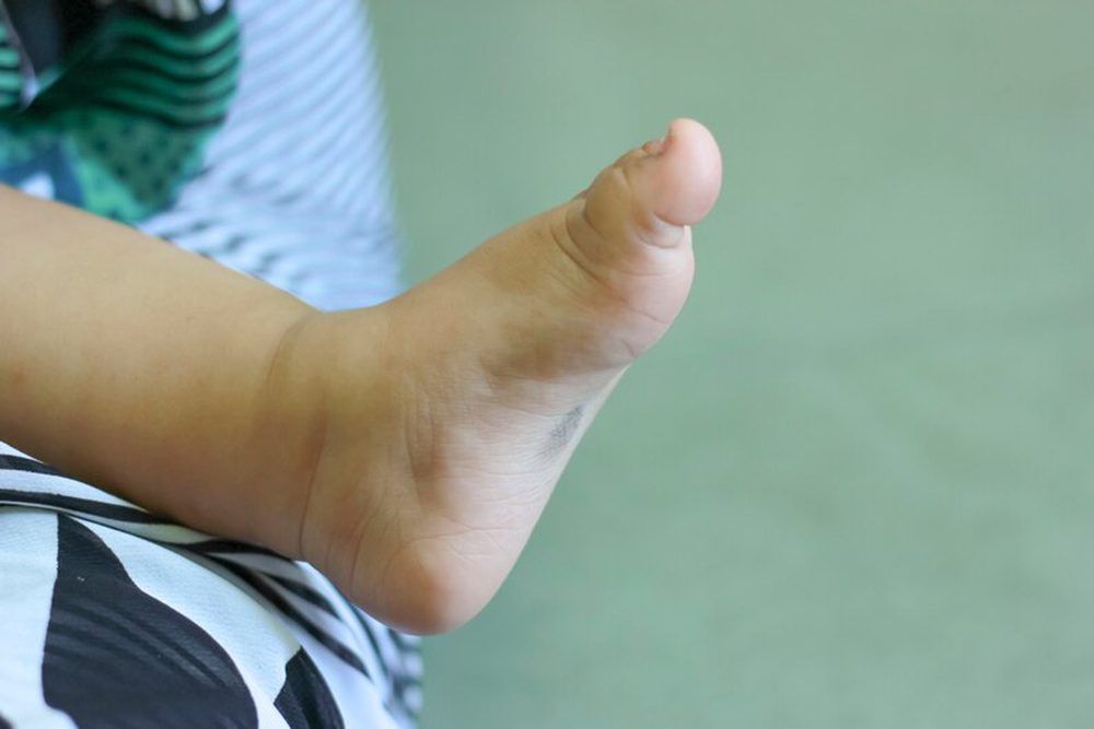 Burger Disease and Wound Care: Effective Methods for Diabetic Foot