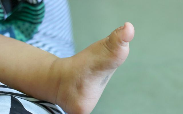 Burger Disease and Wound Care: Effective Methods for Diabetic Foot