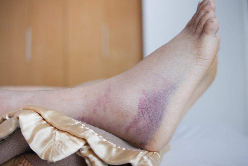 Charcot Foot and Diabetes
