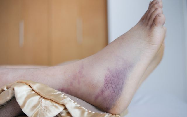 Charcot Foot and Diabetes