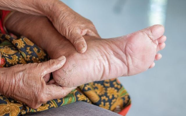 What is Diabetic Foot?