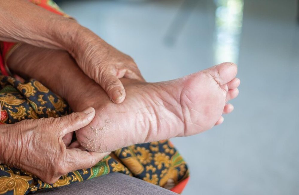 What is Diabetic Foot?
