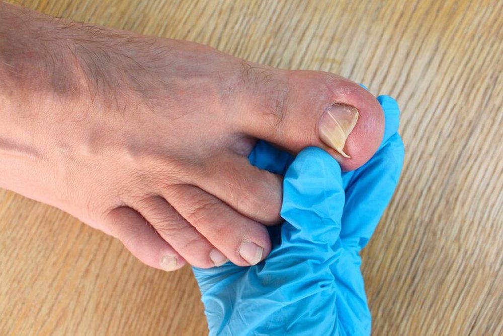 Diabetic Foot: Treatment and Recovery Processes
