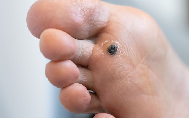 Maggot-Infested Diabetic Foot: What is it, Why Does it Happen, How to Prevent it?